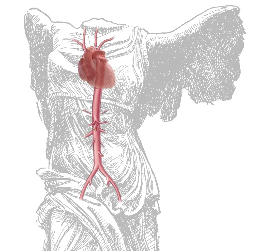 arteritis de Takayasu